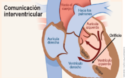 Encontramos un defecto de nacimiento que conecta los dos ventrículos.