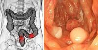 En la imágen podemos observar donde se produce el cáncer: en el intestino grueso.